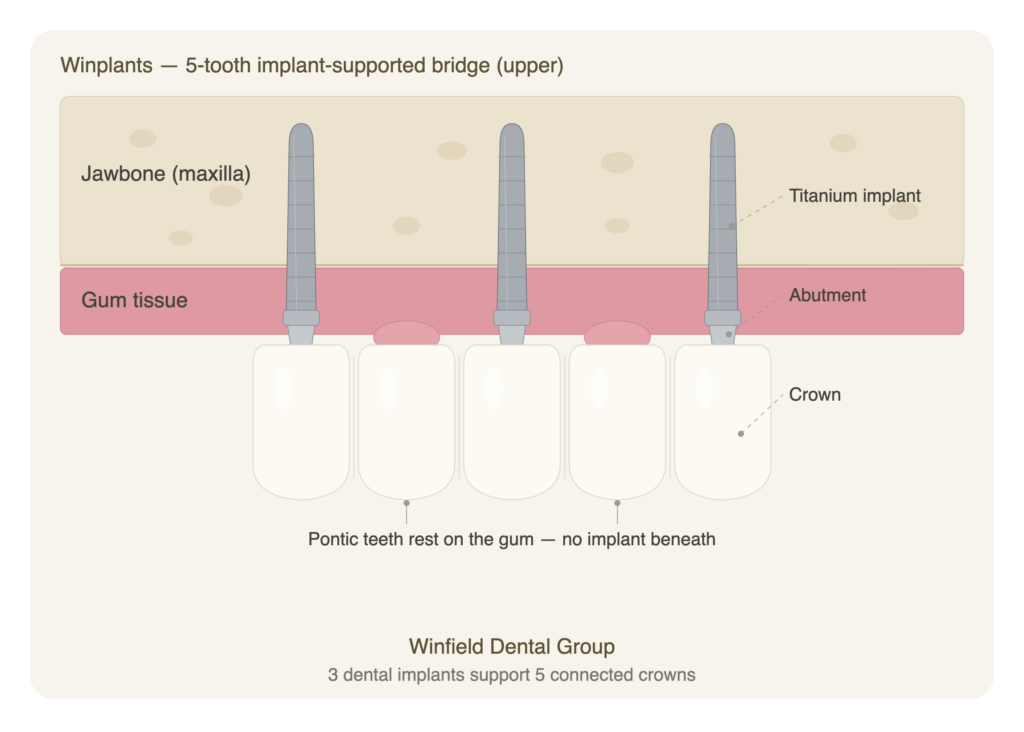 Winplants — 5-tooth implant-supported bridge (upper